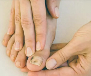 Bất thường ở móng tay cảnh báo loại ung thư da nguy hiểm nhất