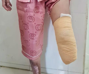 Nữ bệnh nhân 40 tuổi phải cắt cụt chi vì biến chứng loại bệnh hàng triệu người Việt gặp