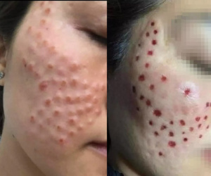 Phát hoảng với gương mặt 'tổ ong nghìn lỗ' vì tiêm da meso