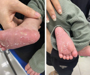 Bé 46 ngày tuổi da bong tróc, quấy khóc, bố mẹ 'tá hỏa' khi biết con mắc bệnh giang mai
