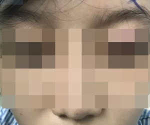 Cắt mí ở thẩm mỹ viện 'chui', người phụ nữ bị thủng 4 lỗ trong mắt