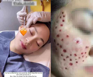 Bất chấp có thể bị biến chứng, một hot girl liều mình tiêm meso