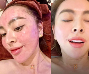 Phát hoảng với hình ảnh Trang Nemo khoe đi làm đẹp nhưng nhìn như bị bỏng nặng