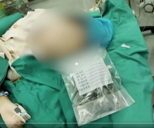Bé gái ăn gần 1kg tóc để được cha mẹ quan tâm