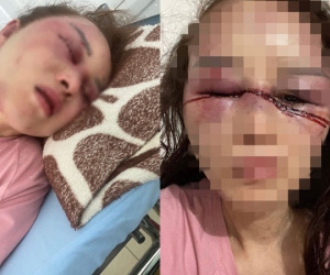 Vụ cán bộ QLTT Thanh Hóa đánh bạn gái dã man: Nạn nhân phải phẫu thuật và theo dõi thêm phần não