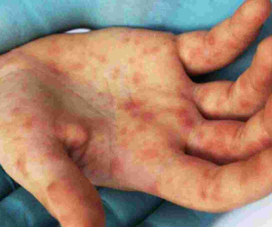 Ấn Độ cảnh báo xuất hiện loại virus mới gây bệnh 'cúm cà chua'