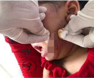 Chó dại tấn công khiến cháu bé 19 tháng tuổi thương tích nặng vùng mặt