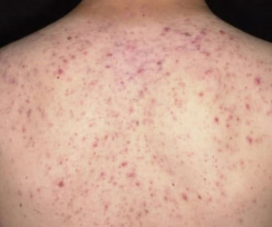 Rối loạn ý thức, suýt tử vong sau 30 phút lăn kim trị mụn ở lưng tại spa