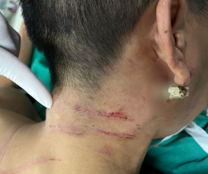 Ngã xe máy, nam thanh niên bị thanh tre đâm xuyên cổ