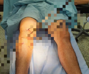 Kinh hoàng cảnh thanh niên bị 5 cây sắt đâm xuyên qua chân