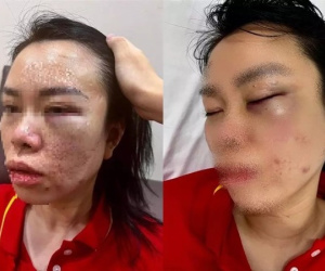 Đưa 'nạn nhân tố bị chồng cũ đánh dã man trong nhiều giờ' đi giám định thương tật