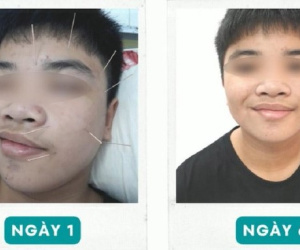 Ngủ dậy, nam sinh tá hỏa vì trúng "khẩu nhãn oa tà"