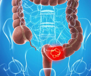 Đi ngoài ra máu, thanh niên 17 tuổi đã bị ung thư trực tràng di căn