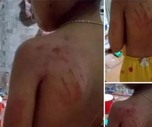 Học sinh lớp 1 bị cô giáo đánh bầm tím vai vì viết chậm