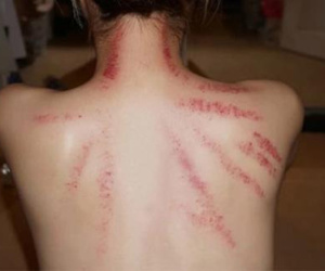Phát hiện bạn gái cởi áo để anh trai kết nghĩa cạo gió hộ, nam thanh niên thắc mắc một chuyện khiến dân tình ngã ngửa: 'Ngây thơ quá vậy!'