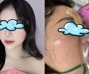 Cô gái 27 tuổi bị mù mắt sau khi tiêm filler nâng mũi: Là mẹ đơn thân nuôi 2 con nhỏ, may mắn giữ được tính mạng