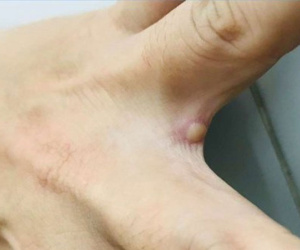 Sức khỏe của bệnh nhân mắc đậu mùa khỉ đầu tiên ở Việt Nam hiện ra sao?