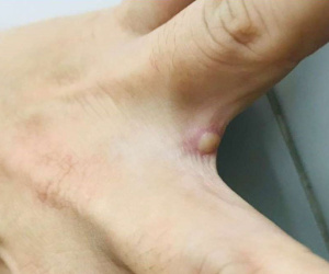 Hình ảnh vết mụn nước ở người mắc đậu mùa khỉ đầu tiên của Việt Nam