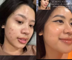 Ngã ngửa mặt mộc chi chít mụn hot girl nổi tiếng gốc Thanh Hóa
