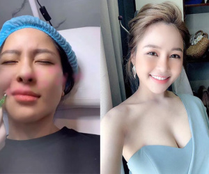 Trâm Anh gây hãi vì khoe cận cảnh tiêm mặt xóa rãnh cười