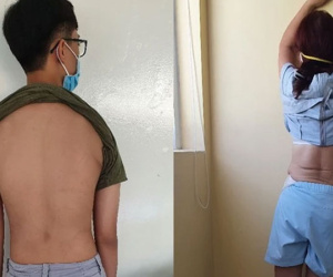 Báo động người trẻ mắc bệnh lý cơ xương khớp với nhiều biến chứng nguy hiểm