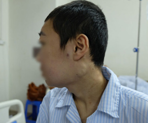 Sưng đau chân, acid uric tăng tưởng do gút, hoá ra mắc ung thư máu