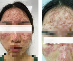 Bôi kem 'detox' trị mụn ở spa, cô gái trẻ ôm mặt chi chít mụn nước, đau rát đến viện cầu cứu bác sĩ