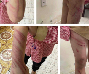 Bé trai 7 tuổi sống với mẹ và 'bố dượng' bị đánh tím bầm ở Hải Phòng