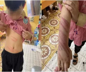 Bố dượng đánh bé trai 8 tuổi bầm dập: 'Bức xúc vì cháu nó hay trộm tiền'