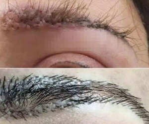 Cấy lông mày người phụ nữ nhận cái kết đáng sợ