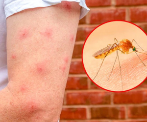 Cùng ở một chỗ, vì sao có người bị muỗi đốt nhiều, người thì không?