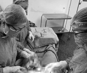 Hi hữu 50 triệu ca mới gặp 1: Người phụ nữ trẻ sinh thai đôi từ 2 tử cung