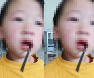 Bé gái 4 tuổi bị thanh sắt đâm vào khoang miệng: Cảnh báo các bậc cha mẹ chú ý trước những vật dụng nguy hiểm