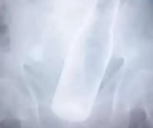 Vỏ chai bia mắc kẹt trong hậu môn, cụ ông đổ lỗi cho... trộm