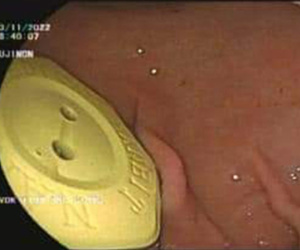 Ngủ quên, nuốt luôn viên đá 'chữa bách bệnh', cụ bà phải nhập viện cấp cứu