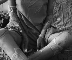 Tự ý dùng thuốc hạ sốt và kháng sinh, cô gái trẻ bị sung huyết, tróc da toàn thân, nguy cơ tử vong 90%