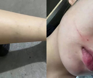 Bầu 7 tháng, thai phụ bị chồng bạo hành đến mức không đi lại được mới dám gọi về cho bố mẹ đẻ