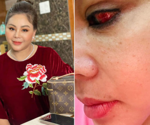 Nghệ sĩ Lê Giang rách giác mạc, tụ máu ở mắt do tai nạn