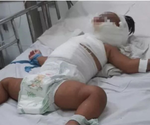 Ngã vào nồi nước sôi mẹ nấu, bé gái 1 tuổi bỏng thương tâm