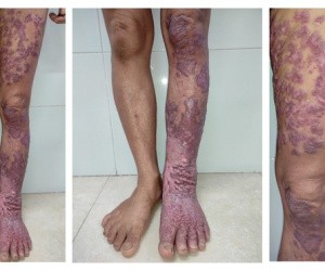 Nhiễm loại nấm da 'bị lãng quên', chân người phụ nữ sần sùi như vỏ cây