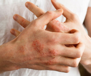 Ngứa khắp người không chỉ là dấu hiệu của bệnh ngoài da