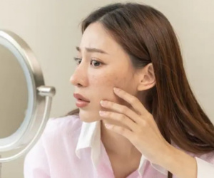 Biện pháp làm mờ sẹo mụn tại nhà để có làn da căng mọng đón Tết