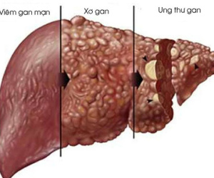 Bác sĩ đưa 'bí kíp' bảo vệ lá gan ngày Tết
