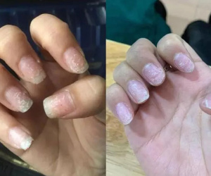 Hoảng hồn với những bộ nail nham nhở sau khi tháo móng giả chơi Tết