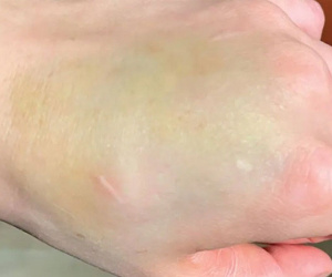 Vết bầm tưởng vô hại trên tay là dấu hiệu ung thư