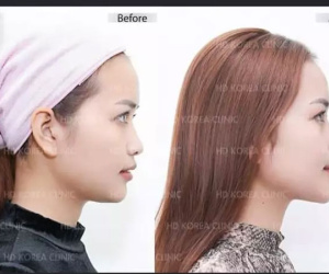 Từng nói 'thời gian đâu phẫu thuật', Hoa hậu Ngọc Châu bất ngờ lộ ảnh sửa toàn bộ khiến netizen tranh cãi dữ dội