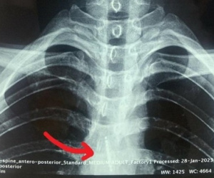 Lý do hy hữu khiến bàn chải đánh răng nằm trong thực quản của nam sinh