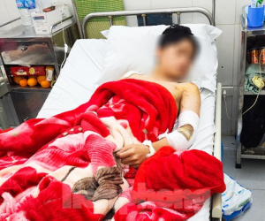 Nam sinh Lào Cai kể phút kinh hoàng bị hai con chó gần 60 kg thả rông cắn