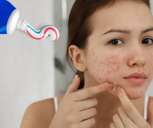 Bắt trend Tiktok 'dùng kem đánh răng trị mụn', mặt nữ sinh 20 tuổi 'nở hoa' phải cầu cứu bác sĩ