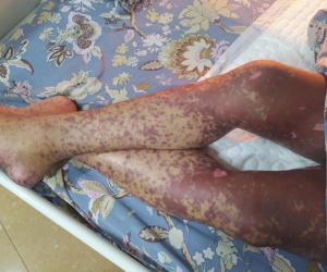 Người đàn ông suýt chết vì tự uống thuốc chữa đau rát họng
